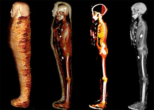 Image of a mummified human body with visible layers and skeleton displayed in different stages, showing its preservation, X-ray, and skeletal structure.