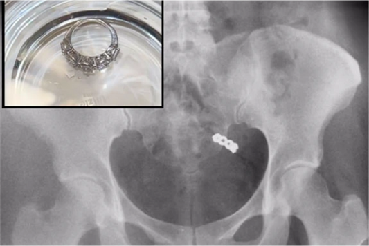 Jet-Lagged Woman Accidentally Swallows Wedding Ring With Handful of Vitamins